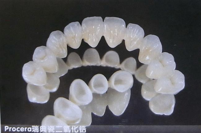 北京优贝口腔贵金属烤瓷牙适合哪些人?使用寿命和材质解析