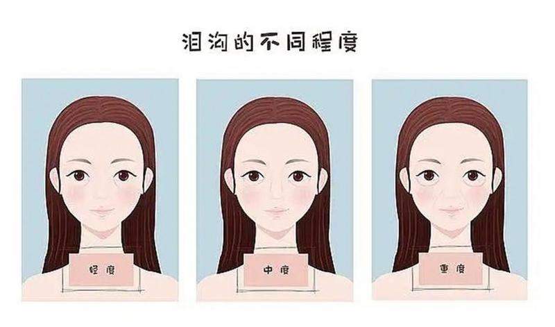 玻尿酸祛泪沟优缺点解析：长沙天心王清波口腔专业指南