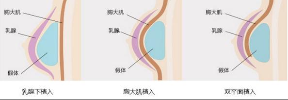宁波艺星时代医疗美容医院(国际JCI认证医院)整形医生有哪些?胸部整形医生简介-优势技术在线获取!