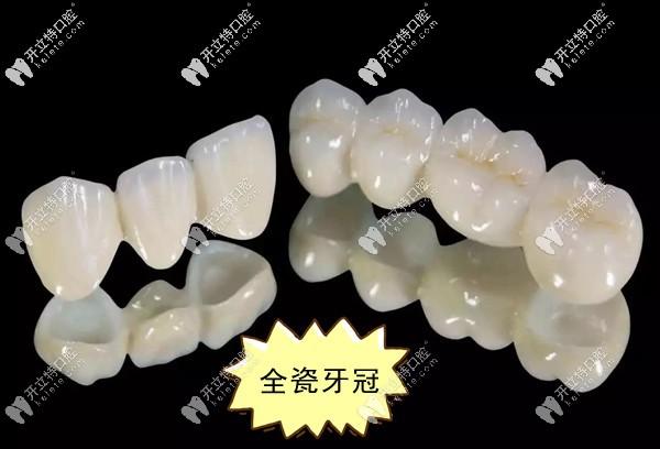 300和500元的烤瓷牙有啥区别？后磨牙缺失1年镶牙选择建议