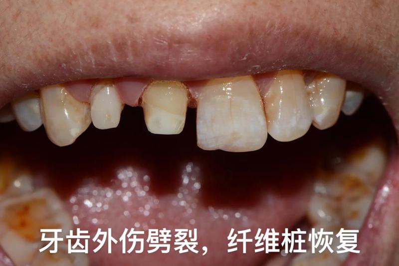 德阳非凡口腔种植牙价格表全解析,种一颗牙到底要花多少钱?