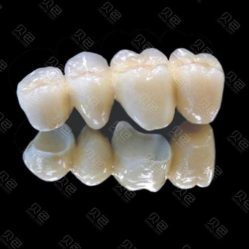二氧化锆全瓷牙和烤瓷牙有什么区别?九江华博口腔专家详解5大核心差异!