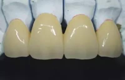 全瓷牙修复效果能维持多久?专业解析使用寿命、护理要点、医院选择等关键因素