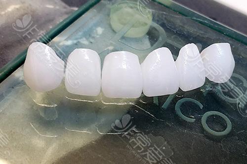 牙冠怎样安装在牙齿上？全瓷牙冠的安装过程及视频可了解