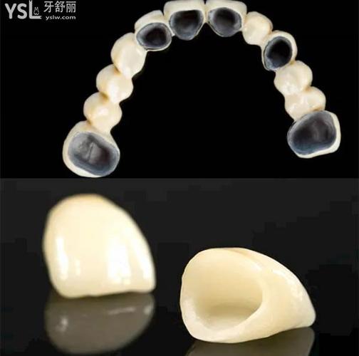 全瓷牙修复技术怎么样?大连瑞泰葆嘉口腔(白山路店)真实案例分享:从缺牙困扰到自信微笑!