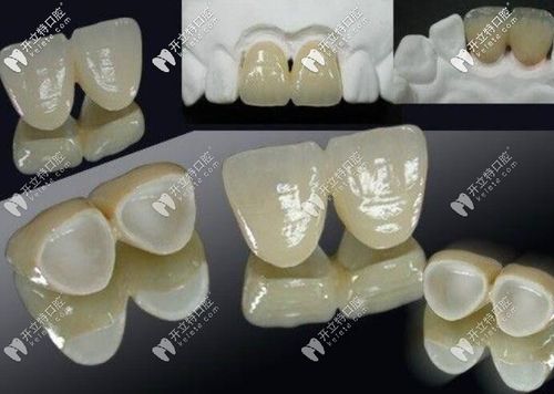 杭州丽致口腔价格表含种植牙6897元起丨牙齿矫正10264元起丨全瓷牙11151元起