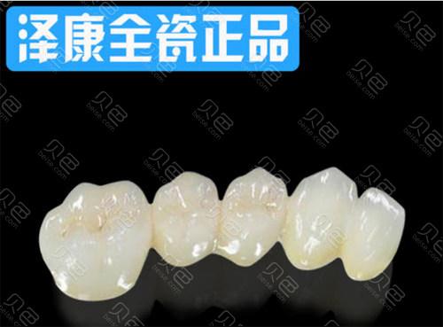 全瓷牙冠选威兰德还是Lava?苏州艾琳口腔专家从材质、耐用性、美观度及性价比解析