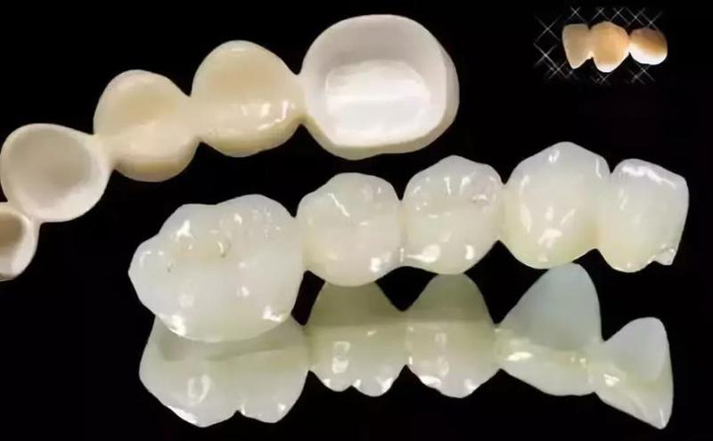 全瓷牙修复效果能维持多久?专业解析使用寿命、护理要点、医院选择等关键因素
