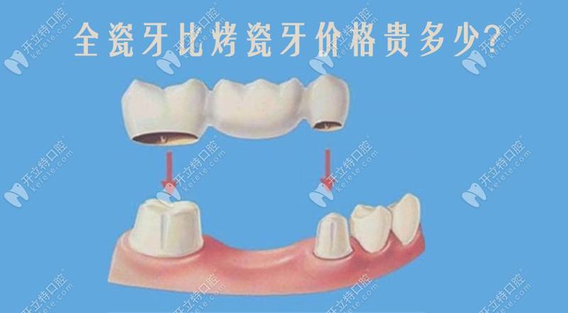 泽武全瓷牙和爱尔创全瓷牙哪个好？详细对比测评告诉你真相！