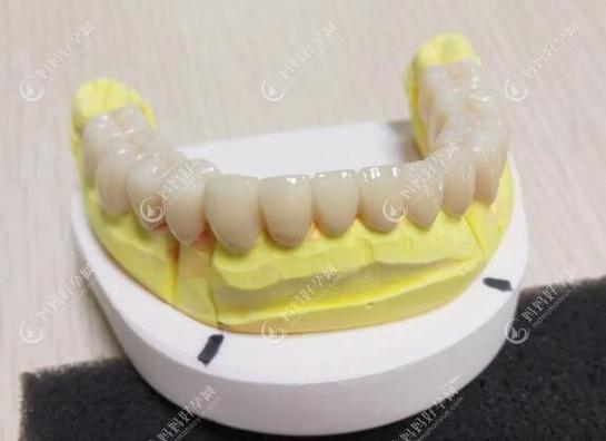 威兰德全瓷牙冠解析：对比烤瓷牙的6大优势、使用寿命及深圳瑞邦齿科专业医生推荐