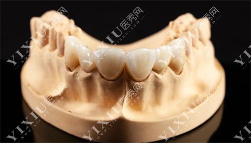 全瓷牙冠与烤瓷牙冠的区别有哪些?使用寿命与适应症解析