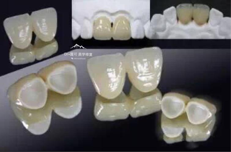 嘉兴晶品口腔牙齿种植技术解析:从评估到长期维护的完整指南