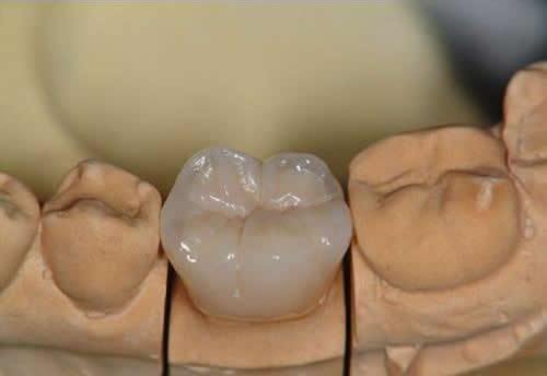 纯钛烤瓷牙容易崩瓷吗？做后牙用全瓷还是纯钛的好呢