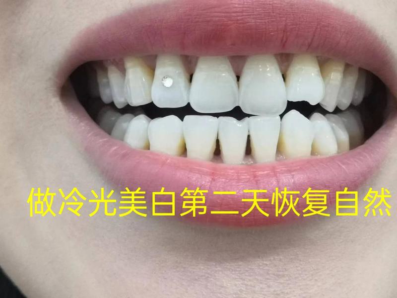 在绵阳臻品全家牙医做种植牙,花费2980元全程舒适体验值得推荐!
