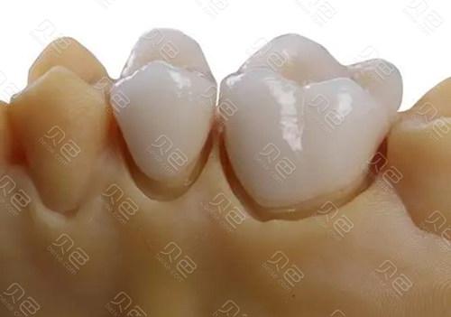 北京圣贝口腔全瓷烤瓷牙专业解析：材质选择与价格对比指南