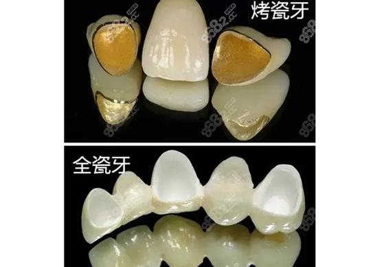 全瓷牙5年真实体验:烟台阚鑫玲口腔患者分享从修复到重获自信的全过程!