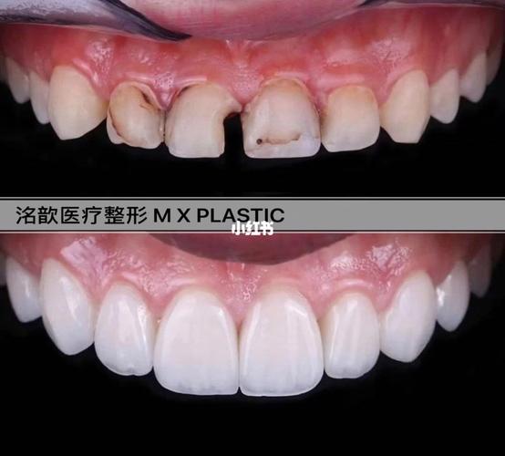 绍兴嵊州海悦口腔收费明细公开!种植牙3680元起-牙齿矫正15800元起-全瓷牙冠1600元起!