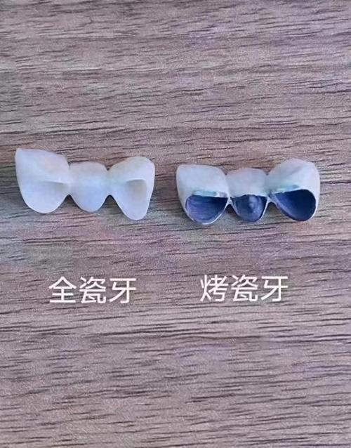 全瓷牙5年真实体验:烟台阚鑫玲口腔患者分享从修复到重获自信的全过程!