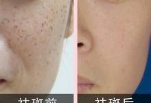 昆明杰西艾整形外科医院祛斑技术怎么样？医院口碑及案例分享