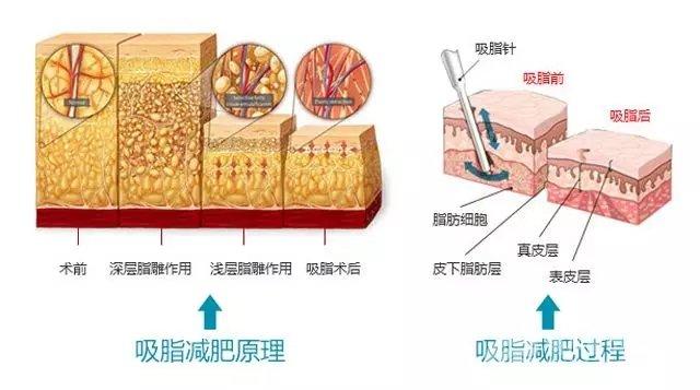 深圳吸脂瘦身整形哪些医