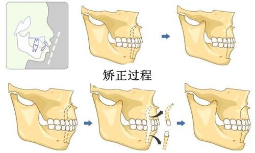矫正牙套什么人好别做这