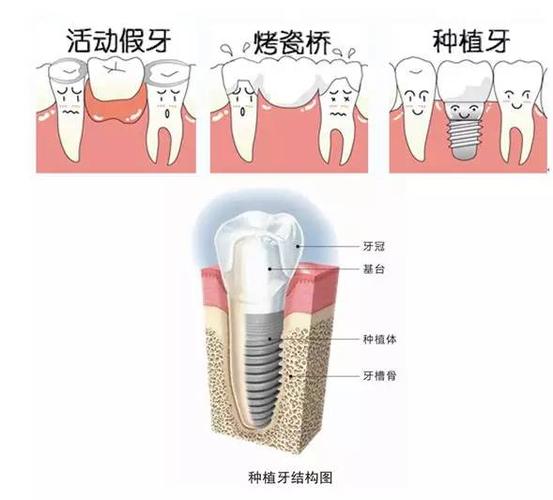 上海正睿口腔医院烤瓷牙怎样价格？肯定比你想的便宜
