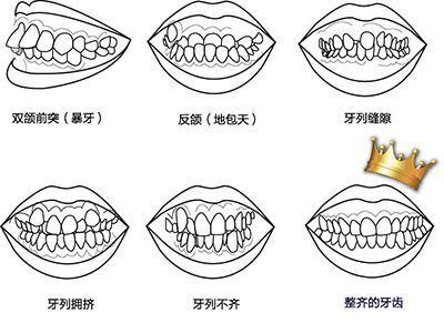 雅美自锁托槽矫正器价格+优势+适用人群一览