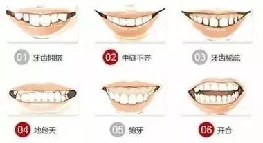 石狮星雅口腔门诊部谢柳萍做正雅隐形矫正12800元起，技术可靠成效好