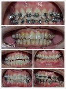 天津希望齿科牙齿矫正价