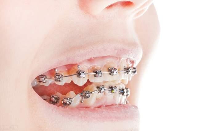 牙齿矫正选哪种方式更美观舒适?晋中海峰口腔医生团队专业解析