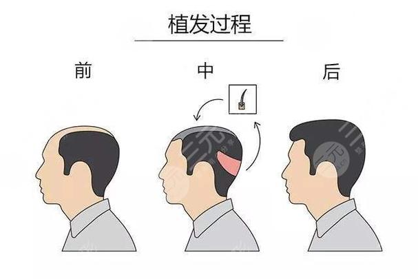 PFUE无痕细胞植发技术的核心优势及真实效果解析——温州佳洁口腔临床案例分享