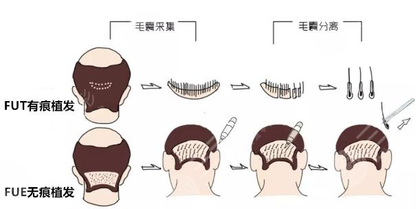 PFUE无痕细胞植发技术的核心优势及真实效果解析——温州佳洁口腔临床案例分享