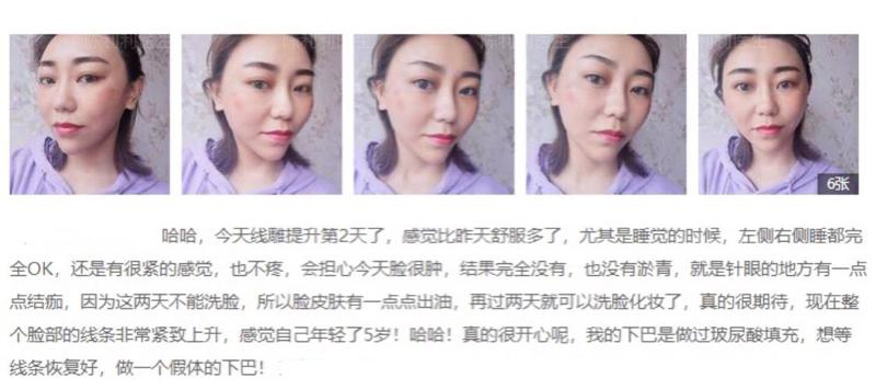 成都军大整形外科医院隆胸技术怎么样?真人案例效果+专家信息
