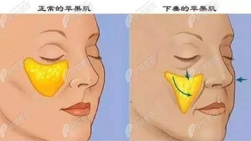 上海交通大学医学院附属新华医院整形外科怎么样?附上眼部整形案例分享+医院具体地址
