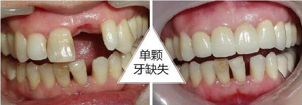 我在晋中榆次刘双全口腔