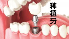 哈尔滨优卓口腔牙齿种植