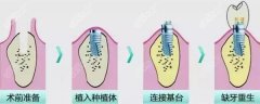 中山种植牙多少钱一颗？