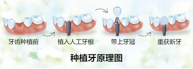 上海宏康口腔全城征集100名牙缺失顾客 瑞士iti种植牙仅9888元