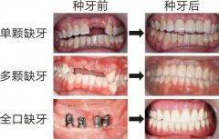 淮南济舟口腔种植牙多少钱？单颗3500元起、半口30000元起、全口