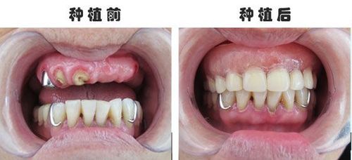 全口假牙什么材质的好？满口树脂牙、纯钛牙、吸附性义齿、种牙.