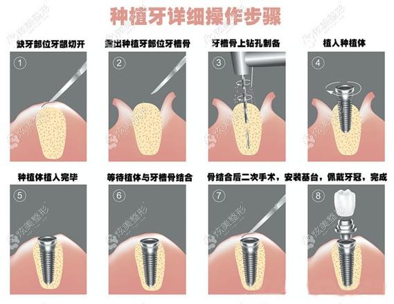 重庆中三口腔闻晨琛医生奥齿泰种植牙2380元起，质量好成效佳