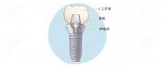 2026自贡种植牙价格表更