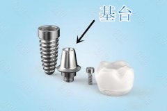 牙齿种植完整费用解析：