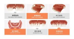 宁波种牙价格一般多少钱