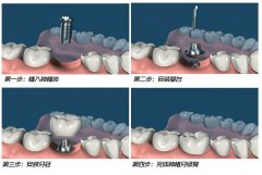 乐山种植牙价格表全新发