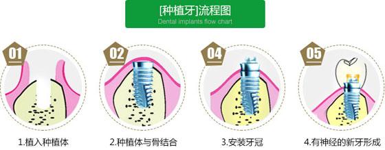 以色列雅定种植体属于几级品牌？一线高端品牌，亲水性档次高