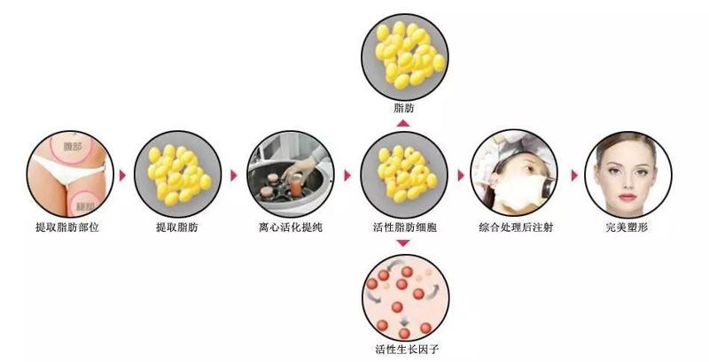长沙吕春柳副主任医师怎么样？隆胸手术详解